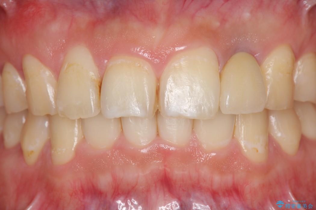 上の前歯のインプラント治療 治療後画像