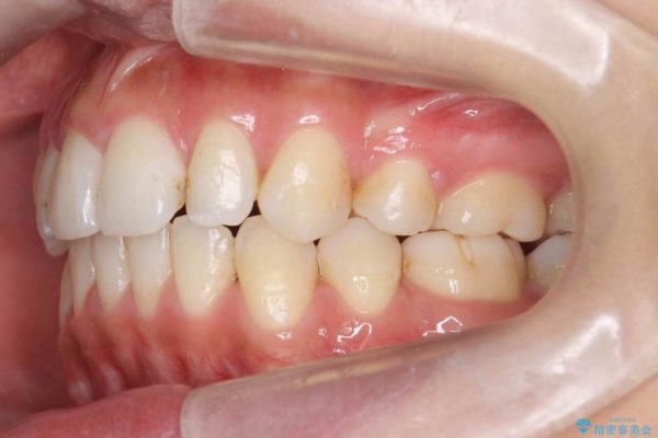 出っ歯(オーバージェット10mm)のワイヤー矯正 治療後画像