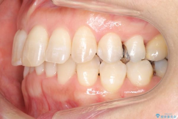 気になる前歯を矯正とセラミックの低予算治療 治療後画像