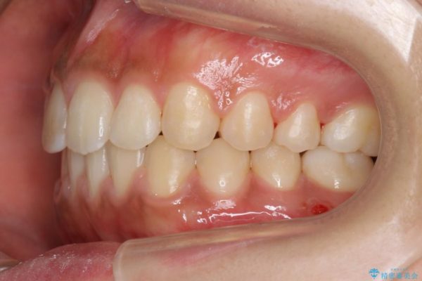 20代女性 すきっ歯の矯正歯科治療 治療後画像