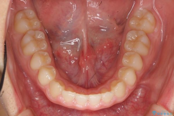 前歯のすき間と過蓋咬合のワイヤー矯正 治療後画像