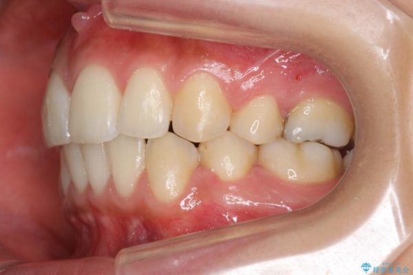 他院で治療した出っ歯の再矯正 治療後画像