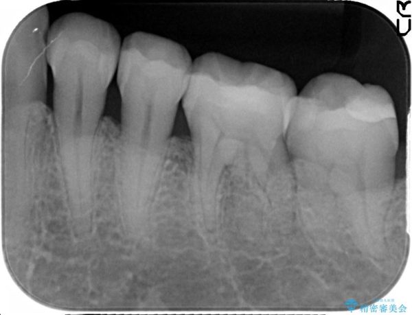 銀歯を白くするセラミックインレー 治療後画像