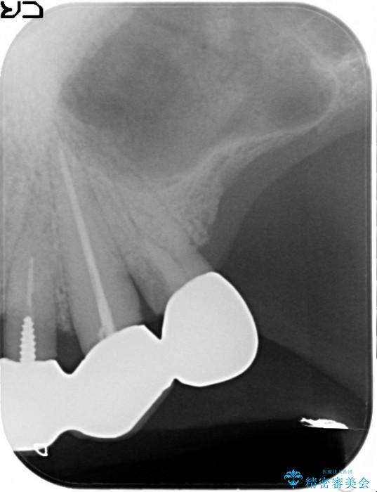 重度歯周病治療(歯槽骨の再生治療) 治療後画像