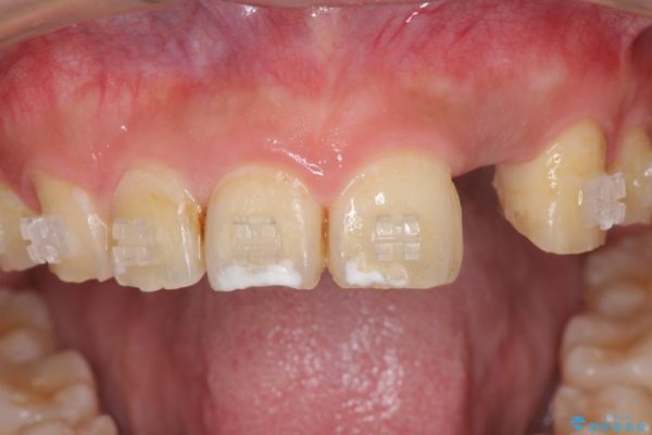 左上前歯のインプラント治療（インプラント埋入まで） 治療後画像