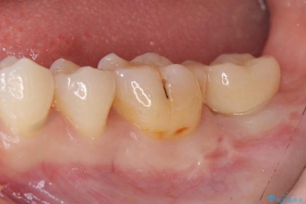 奥歯のストローマン・インプラント 治療後画像