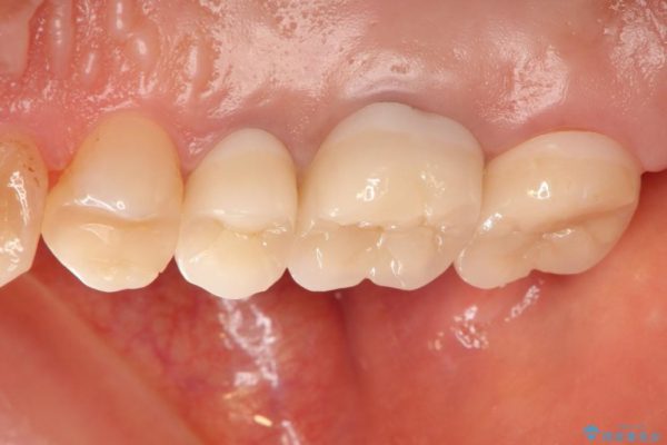 ＜メタルフリー＞銀歯のセラミック治療 治療後画像