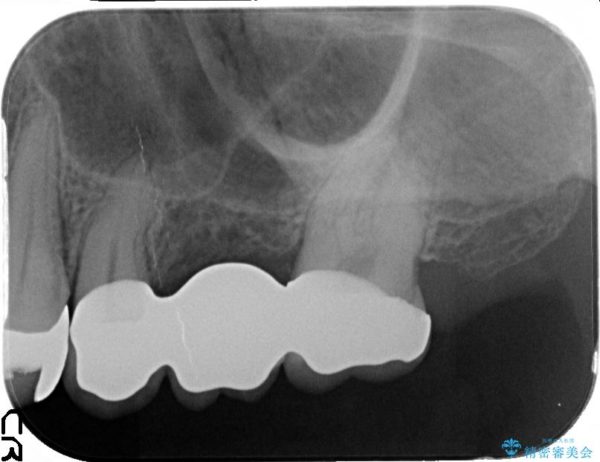 大きな穴があいた奥歯のブリッジ治療 治療後画像