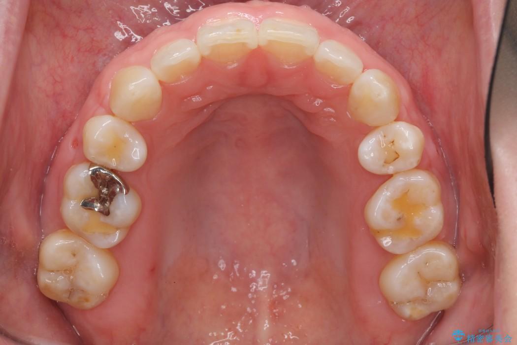 30代女性 出っ歯の再矯正治療 治療後画像