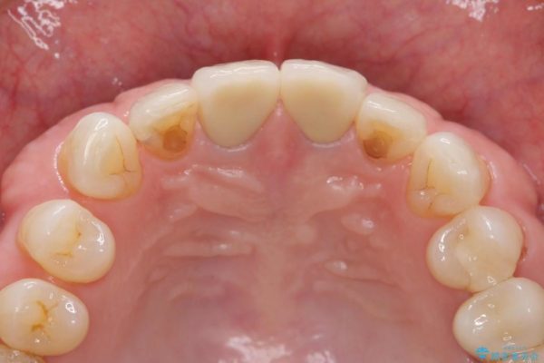 感染根管治療を伴った前歯のセラミック治療 治療後画像