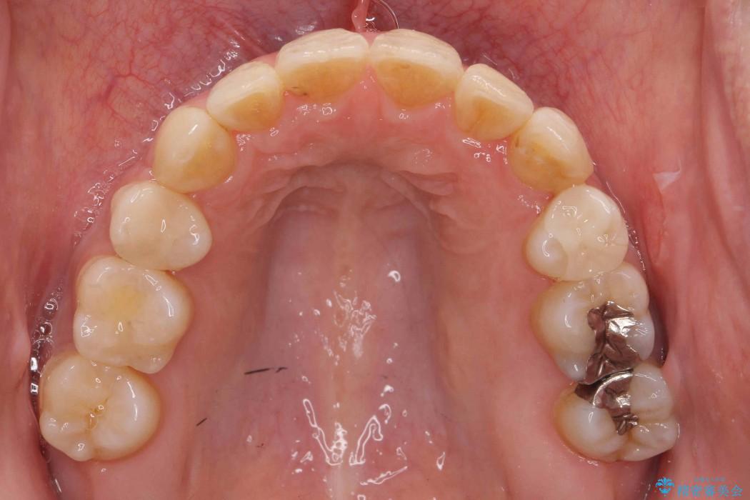 反対咬合（奥歯）のワイヤー矯正治療 治療後画像