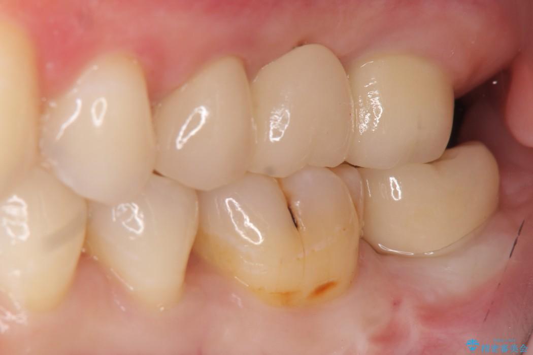 奥歯のストローマン・インプラント 治療後画像