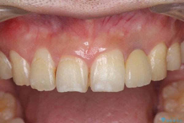 左上前歯のインプラント治療（セラミック治療編） 治療後画像