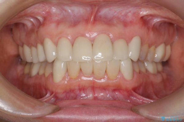 テトラサイクリンによる変色歯のセラミック治療 治療後画像