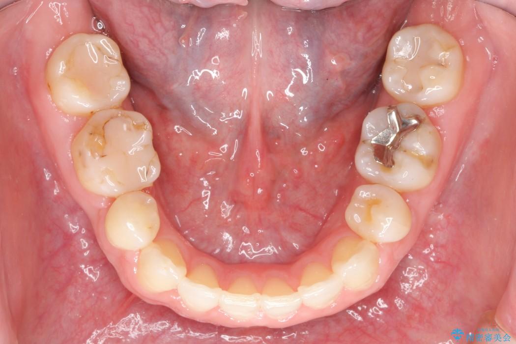 30代女性 出っ歯の再矯正治療 治療後画像