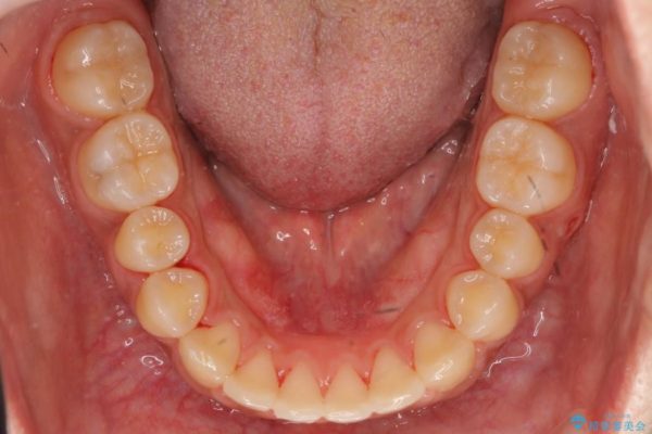 20代女性 すきっ歯の矯正歯科治療 治療後画像