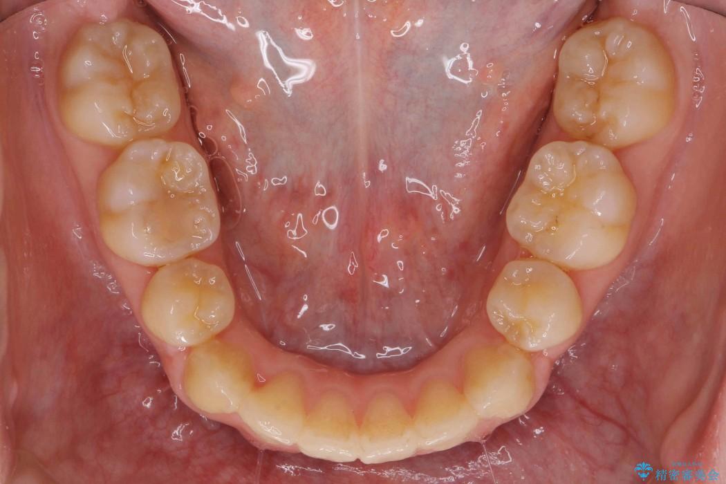 前歯のねじれと出っ歯の矯正 治療後画像