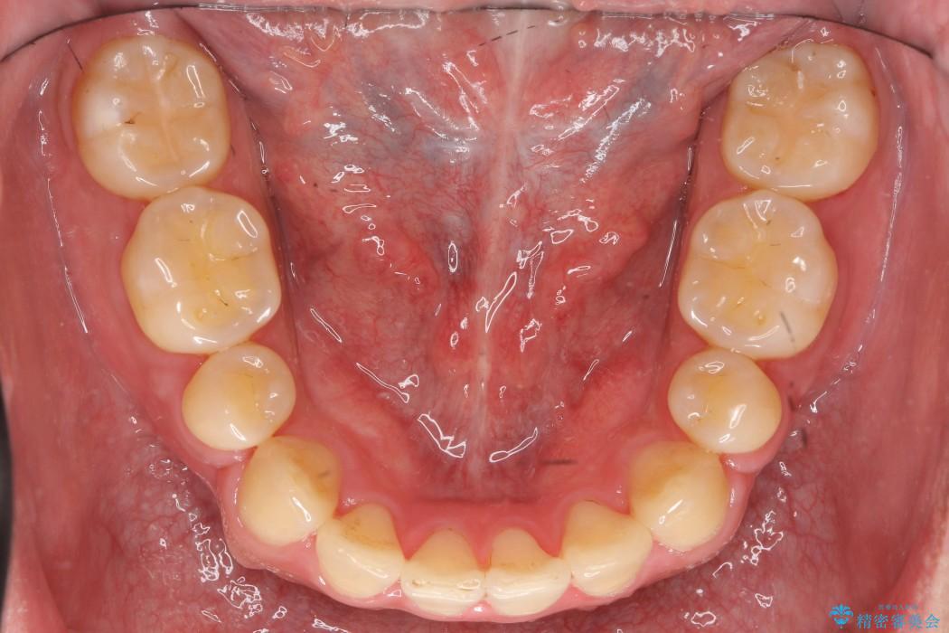 前歯のガタガタと奥歯の噛み合わせの矯正 治療後画像
