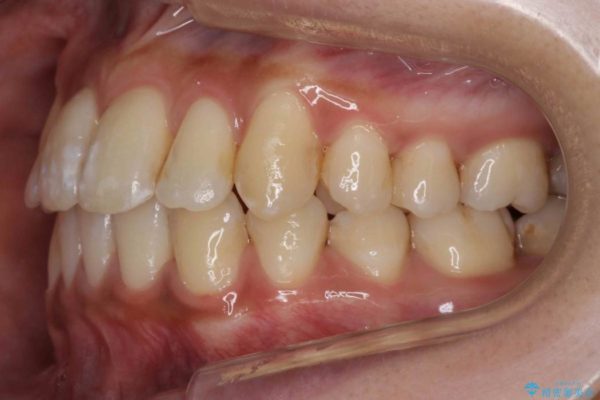 天然歯を活かす、スレ違い咬合矯正 治療後画像