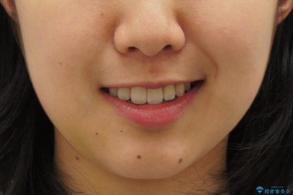 前歯の叢生のインビザライン矯正 治療後画像