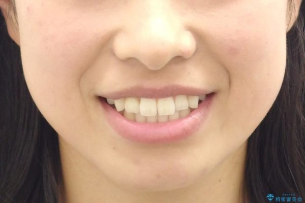 インビザラインで再矯正治療と右上前歯のセラミック治療 治療後画像