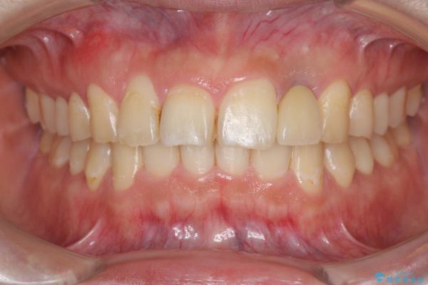 左上前歯のインプラント治療（セラミック治療編） 治療後画像