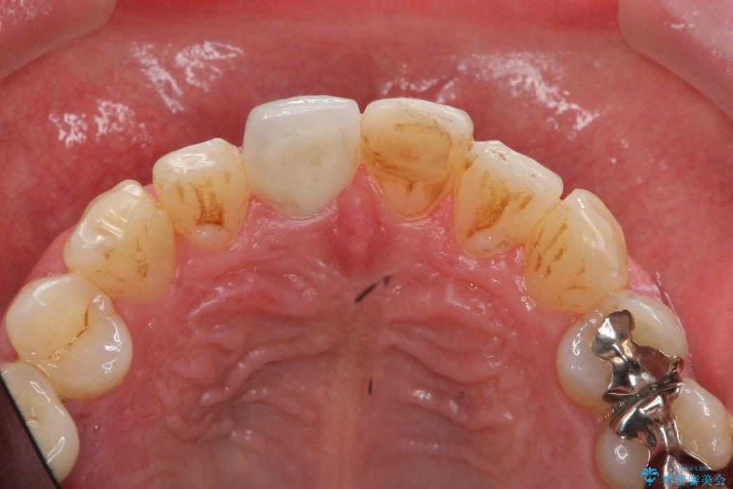 神経が無い歯のセラミック治療 治療後画像