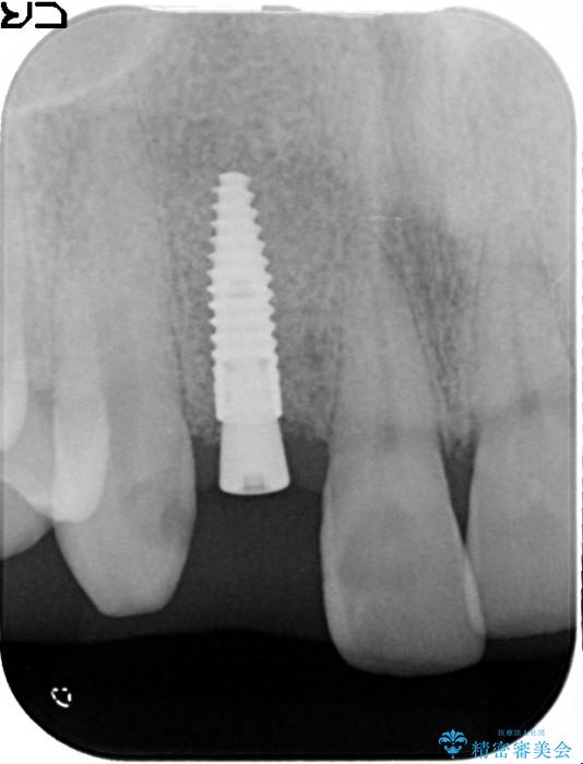 前歯のインプラント治療(インプラント埋入まで) 治療後画像