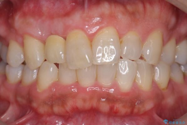前歯のインプラント治療(セラミック治療編) 治療後画像