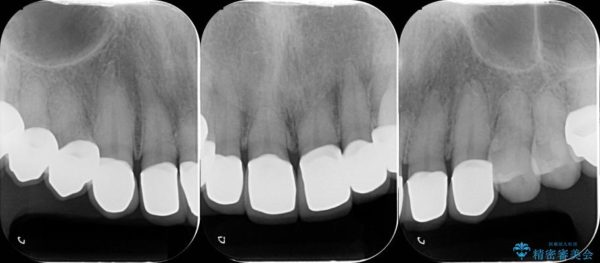 テトラサイクリンによる変色歯のセラミック治療 治療後画像