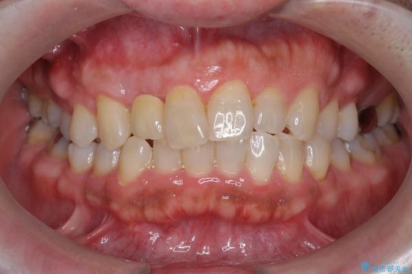 前歯のインプラント治療(セラミック治療編) 治療後画像