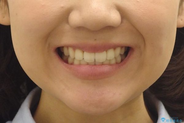 根の短い歯を抜歯 がたがたの歯並び矯正 治療後画像