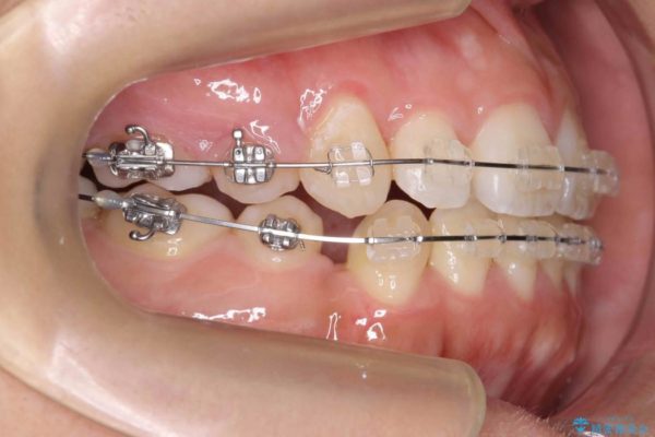 オープンバイト、八重歯の矯正 治療中画像