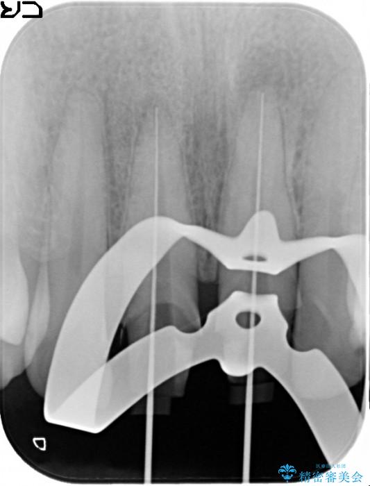 顕微鏡治療を使用した前歯の精密オールセラミック治療 治療中画像