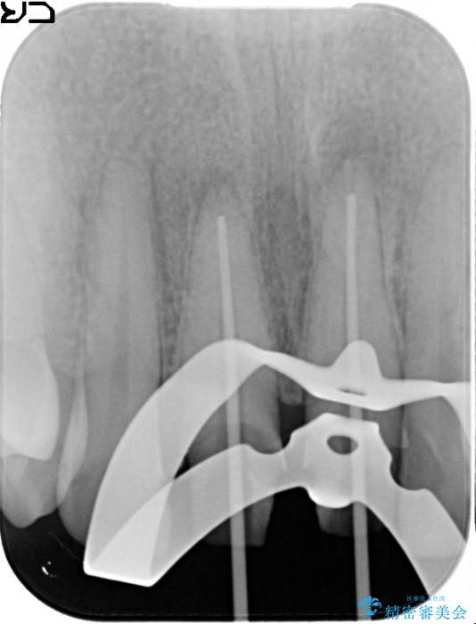顕微鏡治療を使用した前歯の精密オールセラミック治療 治療中画像
