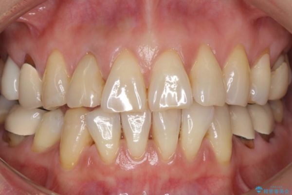 加齢により黄ばんだ歯のクリーニングとホワイトニング 治療前画像