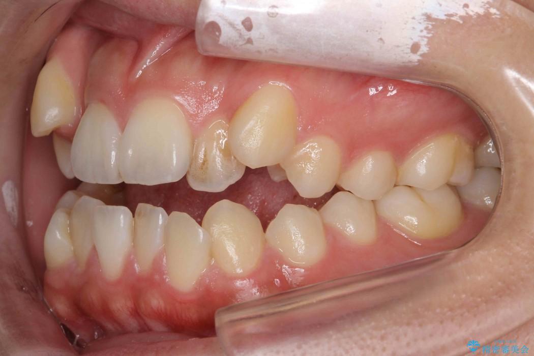オープンバイト、八重歯の矯正 治療前画像