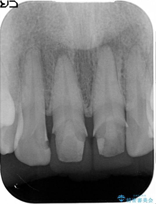 顕微鏡治療を使用した前歯の精密オールセラミック治療 治療前画像