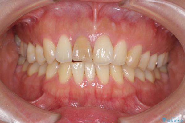 顕微鏡治療を使用した前歯の精密オールセラミック治療 治療前画像