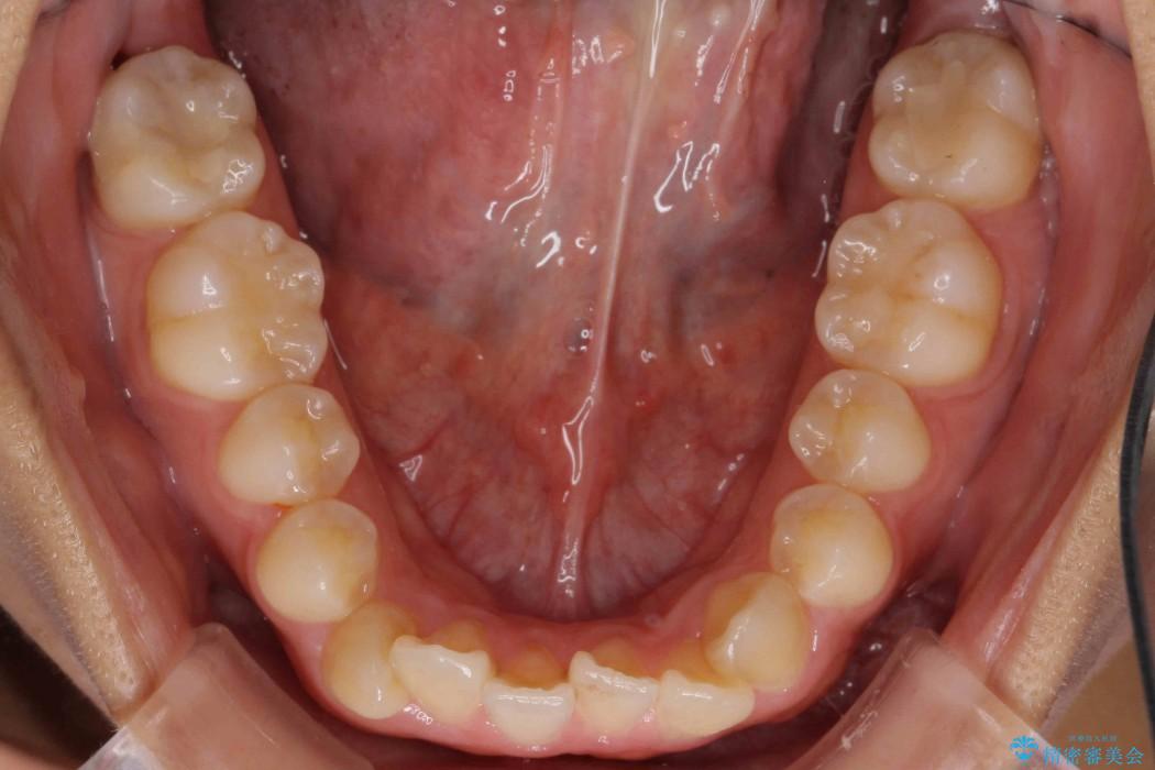 オープンバイト、八重歯の矯正 治療前画像