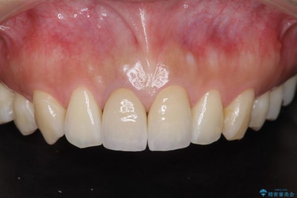顕微鏡治療を使用した前歯の精密オールセラミック治療 治療後画像