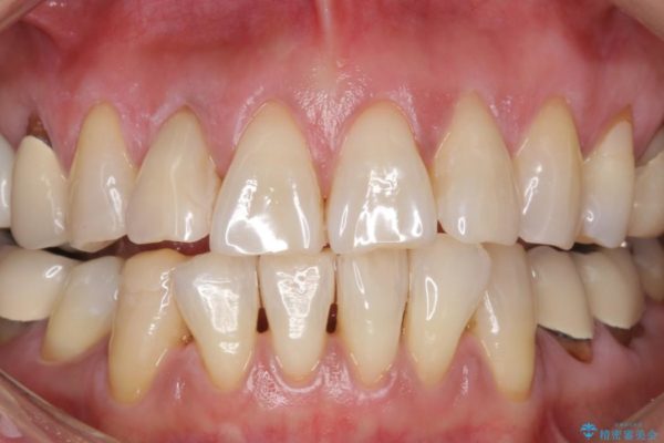 加齢により黄ばんだ歯のクリーニングとホワイトニング 治療後画像