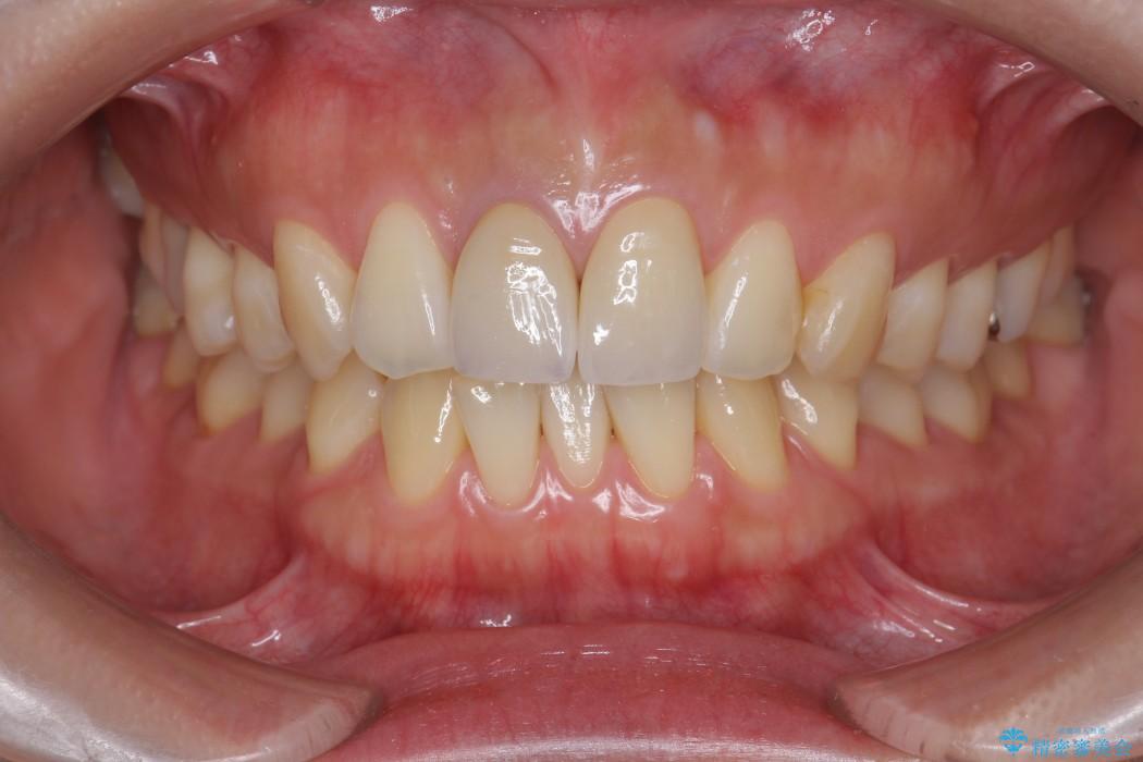 顕微鏡治療を使用した前歯の精密オールセラミック治療 治療後画像