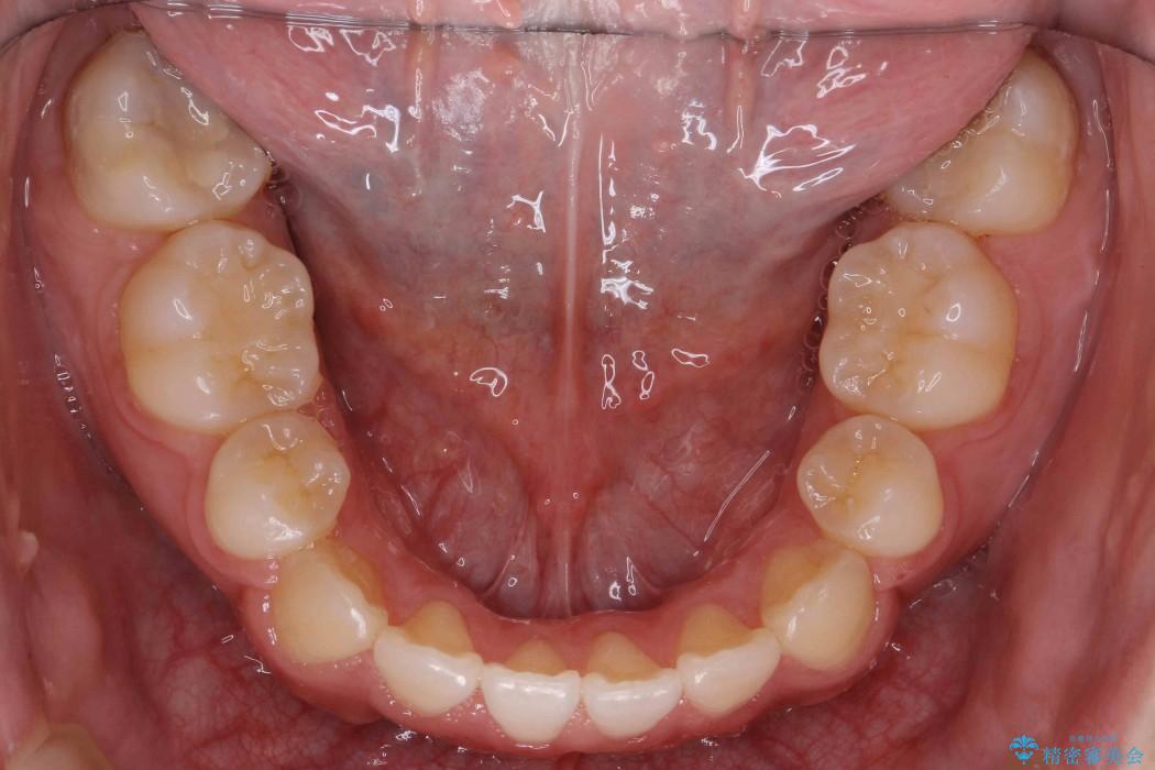 オープンバイト、八重歯の矯正 治療後画像