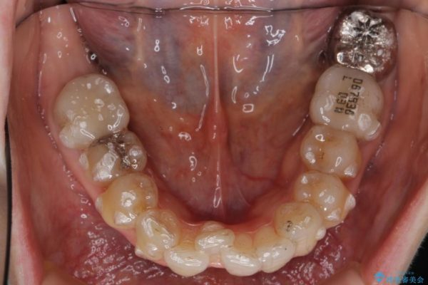 歯並び・虫歯・根っこ（根管）の総合歯科治療 治療中画像