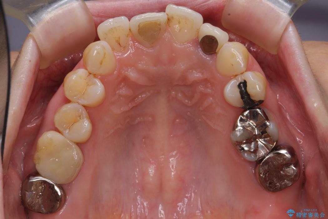 歯並び・虫歯・根っこ（根管）の総合歯科治療 治療前画像