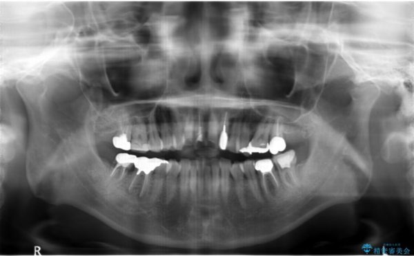 歯並び・虫歯・根っこ（根管）の総合歯科治療 治療前画像