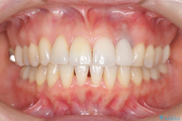 歯並び・虫歯・根っこ（根管）の総合歯科治療 アフター
