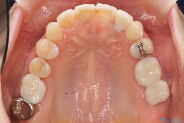 歯並び・虫歯・根っこ（根管）の総合歯科治療 治療後画像
