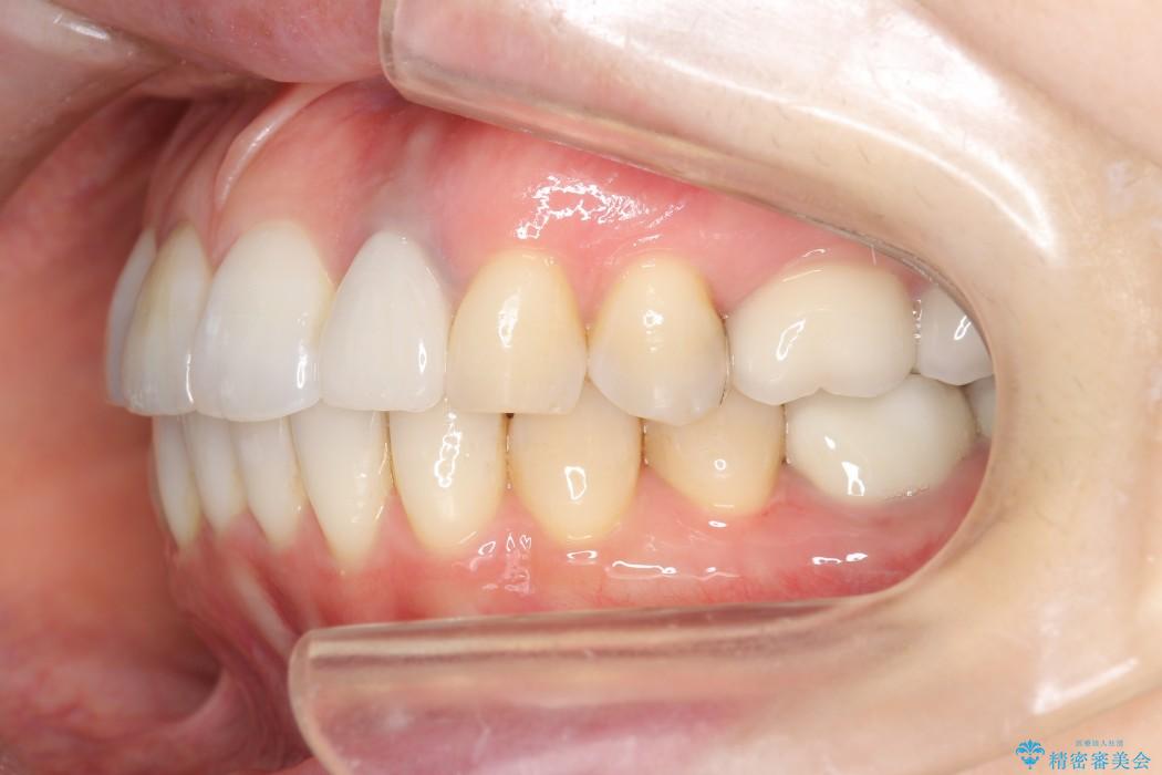 歯並び・虫歯・根っこ（根管）の総合歯科治療 治療後画像